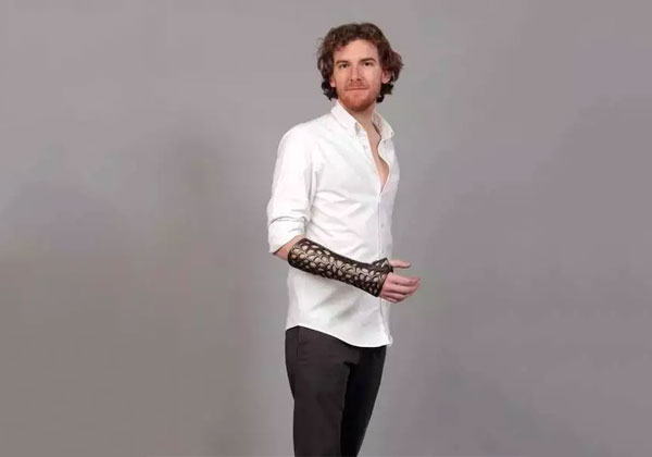 骨折不再打石膏，現在有 3D 打印骨骼矯正器